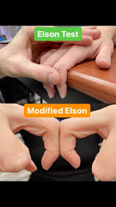 Image result for Elson Extensor Tendon Test