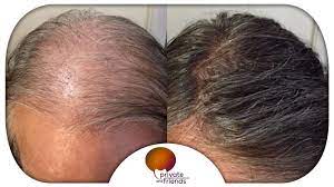 Una selezione di protesi capillari standard da uomo realizzati interamente a mano, con capelli remy e capelli europei. Protesi Capelli Uomo Nuova Generazione Private And Friends