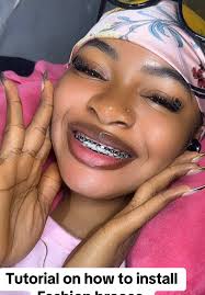 How to Install Fashion Braces at Home