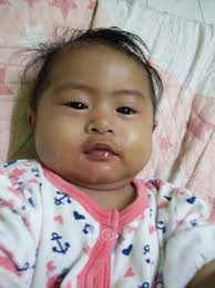 Penyumbatan air mata pada bayi disebabkan oleh penyumbatan saluran air mata ke hidung oleh selaput hasner pada saat bayi lahir sehingga, mata bayi berair dengan tidak normal. Anak Dijangkiti Penyakit Impetigo