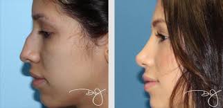 Epingle Sur Rhinoplasty