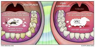 Other causes may include chronic irritation from: Leukoplakia Vs Oral Candidiasis Medcomic