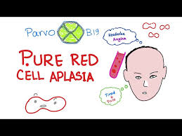 1, 2 erythroblasts are virtually absent in bone marrow; Pure Red Cell Aplasia Youtube