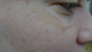 Image result for Melasma