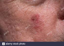Blutgerinnsel (thromben) können in arterien oder venen auftreten. Tumor Unter Der Haut Stockfotos Und Bilder Kaufen Alamy