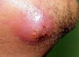 Scratching or picking at the ingrown hair. Ingrown Hair Bad Ingrown Hair On Vag