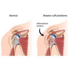 The human shoulder is made up of three bones: Rotator Cuff Injury Tear Tendonitis Shoulder Specialist Boise Meridian Nampa Id