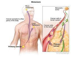 Bladder Cancer Medlineplus Genetics