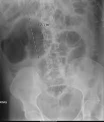 Mobile Cecum Syndrome | Ppt
