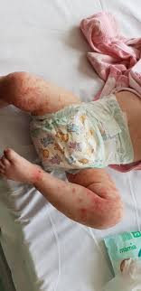 Roseola is a viral infection that causes a rash and a high fever. Mom Speaks Out After Daughter Gets Herpes From Stranger Kissing Her On The Lips People Com