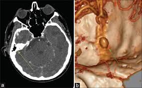 The middle meningeal artery (latin: Middle Meningeal Artery Aneurysm Case Report Surgical Neurology International