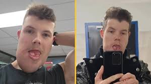 Man born with rare condition forced to pick between his face or voice