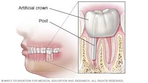 Tips and instructions to follow after your root canal appointmentwondering what to expect after a root canal? Slide Show Root Canal Treatment Mayo Clinic
