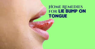 All The Home Remedies For Lie Bumps On Tongue That Have Been Discussed Here Are Tried And Tested Ones Lie Bumps On Tongue Bumps On Tongue Sore On Tongue Remedy