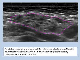 Image result for Submandibular Exam