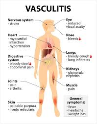 Pin On Vasculitis