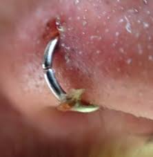 Infected Nose Piercing Causes Nose Piercing Bump Nose Piercing Piercing Bump