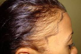 The best hairstyles for women with receding hair a receding hairline refers to hair receding from the natural hairline on the sides and top of the forehead female receding hairlines have many causes including genetics aging and hormonal changes due to pregnancy and stress 25 ideal hairstyles for women with receding hairlines 25 ideal hairstyles. 9 Ways To Save A Receding Hairline Bebe Akinboade