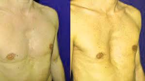 Pectus excavatum is the main cause of rib flare. Pectus Excavatum Diseases And Conditions Pediatric Oncall