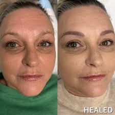 I had quite uneven, sparse brows with a scar that went right through my  brow! Tess made them look perfectly natural! I feel so much more confident  and my eyes feel