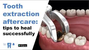 Once your tooth's extraction procedure has been completed, you'll no doubt want to know how long it will take for its socket to heal. Tooth Extraction Healing Info And Tips For Correct Aftercare Dental Coach