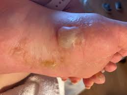 Image result for pompholyx soles of feet