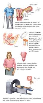 Any type of pain lasting more than a few days, or pain that does not go away, needs to be evaluated by a doctor. Vaginal Cancer Spectrum Health