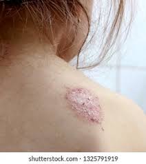 Image result for Eczema nummulare