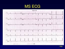 Hemodynamic studies in relation to clinicaldisability. Ppt Valvular Heart Disease Powerpoint Presentation Free Download Id 4330866