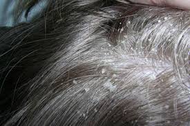 Tea Tree Oil For Dandruff Uses And Benefits Dry Scalp Remedy Dry Scalp Treatment Oils For Dandruff