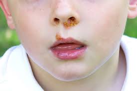 Image result for yellow scabs on the face in children