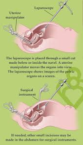 Minimally Invasive Fertility Surgery Laparoscopy Hysteroscopy Fertility Answers