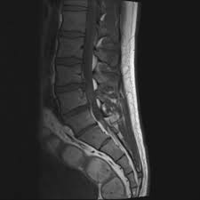 We did not find results for: Cauda Equina Syndrome Radiology Case Radiopaedia Org