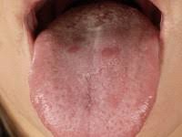 Maybe you would like to learn more about one of these? Syfilis Syphilis Lues Soa