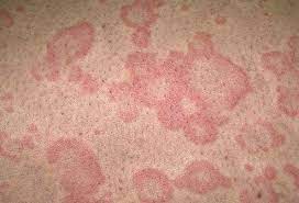 Pin By Integumentary System On 3 Owynn Skin Rashes Pictures Common Skin Rashes Hives Relief