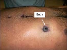 Feb 14, 2009 · gunshot wounds resulted in gross tissue destruction that was an excellent medium for infection. Multiple Suicidal Firearm Injuries A Case Study Sciencedirect