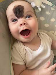 Hatalmas anyajeggyel a homlokán született a kisbaba