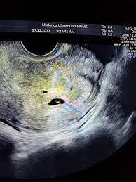 When did i conceive if i am ____ weeks pregnant when did i conceive? Page 2 How Long Did It Take You To Get Pregnant After Ectopic Mumsnet