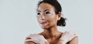 Expert And Effective Vitiligo Treatment At The Day Clinic