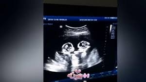 Janin yang terlihat tersebut masih berupa titik janin saat usia kehamilan masih 5 minggu. Viral Lucunya Bayi Kembar Seolah Adu Jotos Saat Usg Lihat Videonya Di Sini Tribun Manado