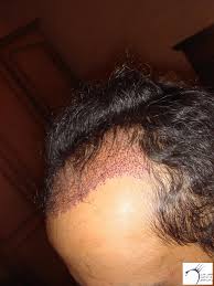 تجربتي بزراعة الشعر بسام الجباعي الأربعاء 9 6 2010 المنتدى العربي لزراعة الشعر وعلاج الصلع