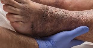 Some skin discoloration could be completely harmless and vanish as quickly as it appeared. Stasis Dermatitis And Ulcers Causes Symptoms And Treatment