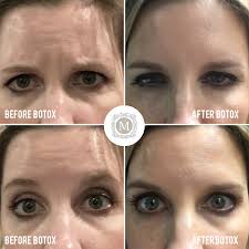 Fda approved in 2011 in the united states. This Patient Had 40 Units Of Botox For Forehead Wrinkles Frown Lines Lines Between The Brow And Crows Feet Hide Wrinkles Forehead Wrinkles Botox
