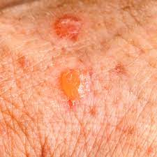 If you aren't sure which type of skin cancer. Pictures Of Moles Nevus Actinic Keratosis Psoriasis