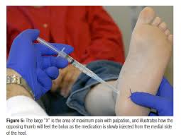 If the first few steps you take in the morning are painful, you might be experiencing plantar fasciitis. Effective Protocol For The Management Of Plantar Fasciitis