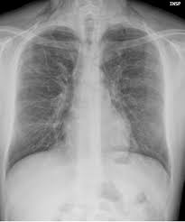 Image result for Chest XRay Interpretation