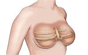 Check spelling or type a new query. Elevacion De Pecho O Sujetador Interno