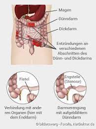 Bei blut im stuhl bekommen viele menschen angst, da man im ersten moment immer an darmkrebs denkt. Morbus Crohn Ursachen Symptome Therapie Ernahrung Netdoktor