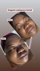 Eminence Skin Care Before and After