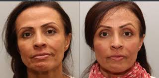 This beneficial treatment requires at least three visits to lasermed skin and vein clinic. Sculptra Aesthetic Face Torrance Ca Lumier Medical